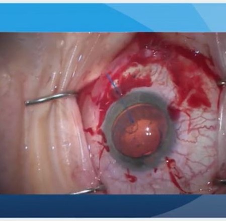 Loose Zonules Webinar